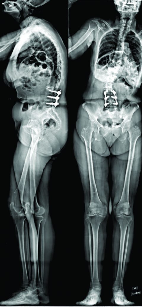 Figure 1: Pre-operative anterio-posterior and lateral radiographs