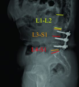 Figure 2: Pre-operative sagittal radiographic analysis 