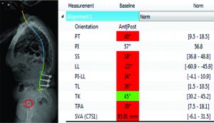 Figure 3: Pre-operative segmental analysis of lumbar lordosis