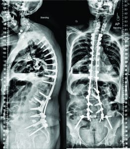 Figure 4: Post-operative anterio-posterior and lateral radiographs