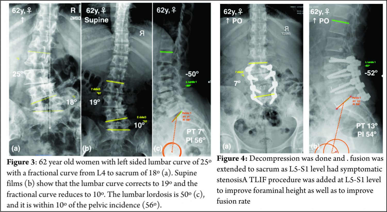 Management Strategies And Selection Of Fusion Levels In Adult Spinal 